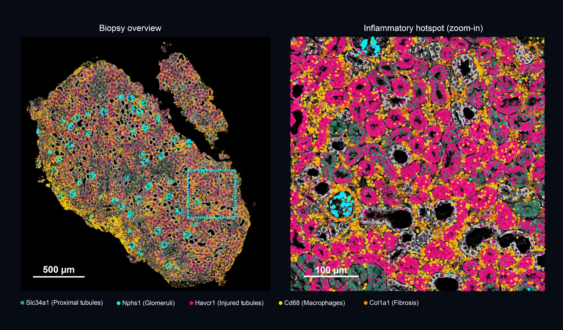 Xenium image from a day 3 kidney biopsy demonstrating fulminant glomerulonephritis